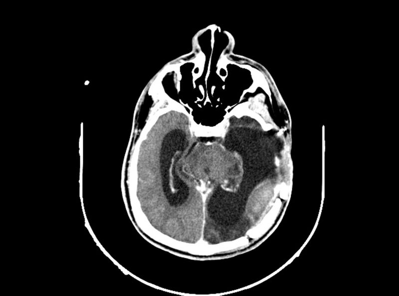 File:Brain injury by firearm projectile (Radiopaedia 82068-96088 B 112).jpg