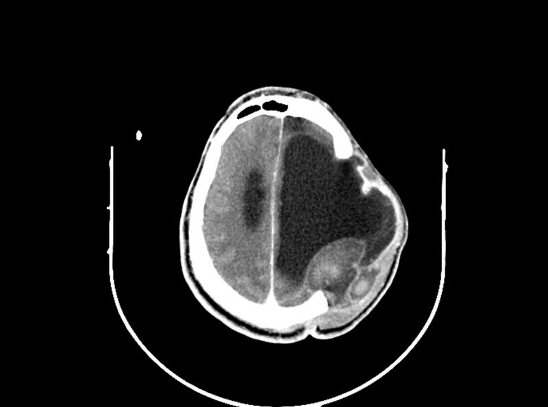 File:Brain injury by firearm projectile (Radiopaedia 82068-96088 B 166).jpg