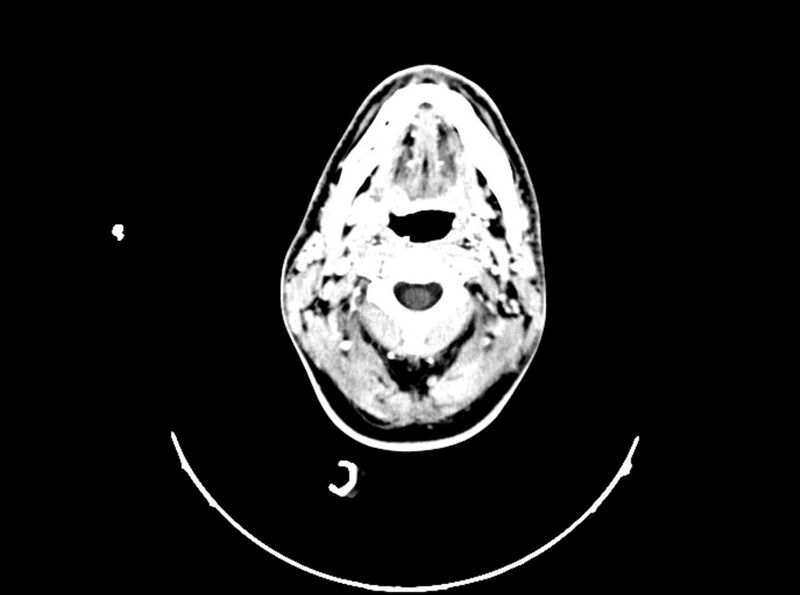 File:Brain injury by firearm projectile (Radiopaedia 82068-96088 B 35).jpg