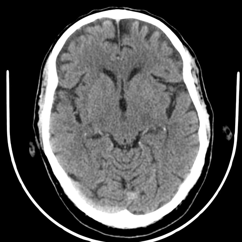 Brain metastasis (Radiopaedia 42617-45760 Axial non-contrast 19).jpg