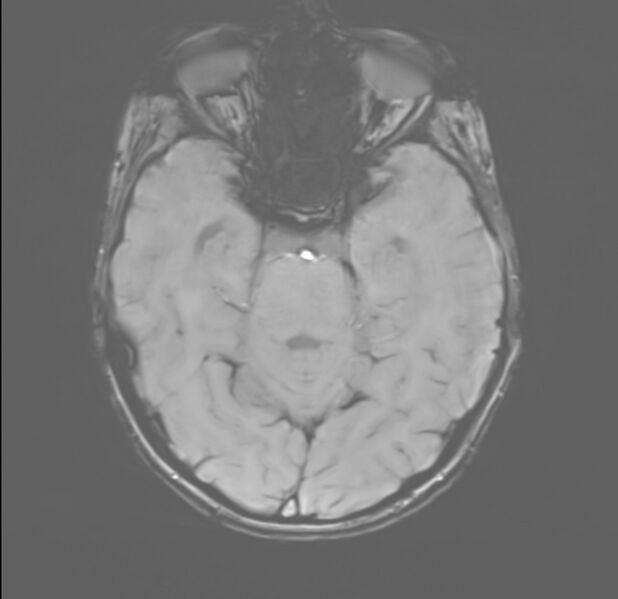File:Brainstem glioma (Radiopaedia 70548-80674 Axial SWI 20).jpg