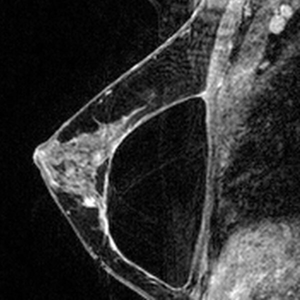 File:Breast implants - MRI (Radiopaedia 26864-27035 Sagittal T2 102).jpg