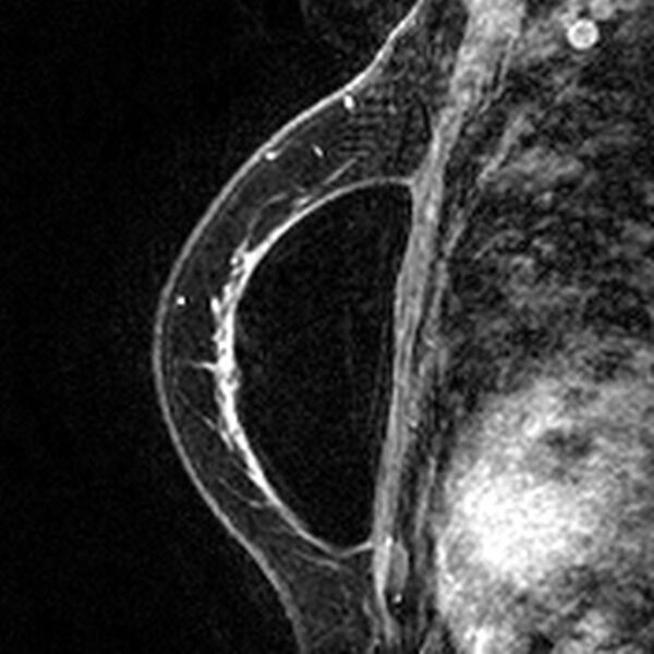 File:Breast implants - MRI (Radiopaedia 26864-27035 Sagittal T2 39).jpg