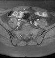 Broad ligament leiomyoma (Radiopaedia 81634-95516 Axial T1 fat sat 2).jpg