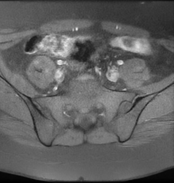 File:Broad ligament leiomyoma (Radiopaedia 81634-95516 Axial T1 fat sat 2).jpg