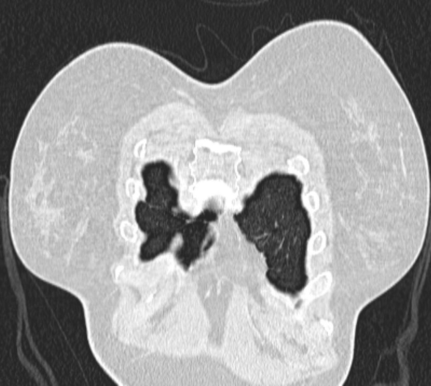 Bronchial atresia (Radiopaedia 50007-55297 Coronal lung window 1).jpg