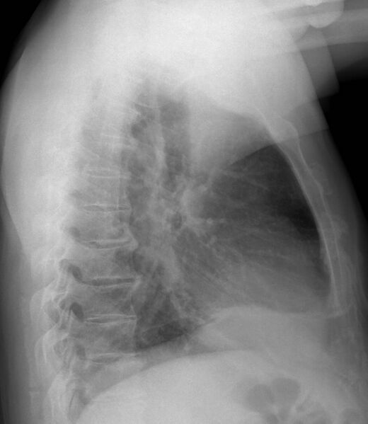 File:Bronchial carcinoid tumor with right lower lobe collapse (Radiopaedia 29060-29423 Lateral 1).jpg