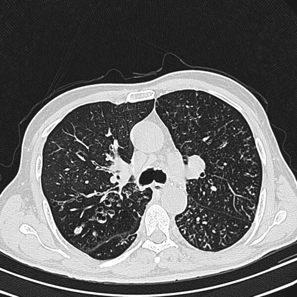 File:Bronchiectasis (Radiopaedia 22061-22059 lung window 12).jpg