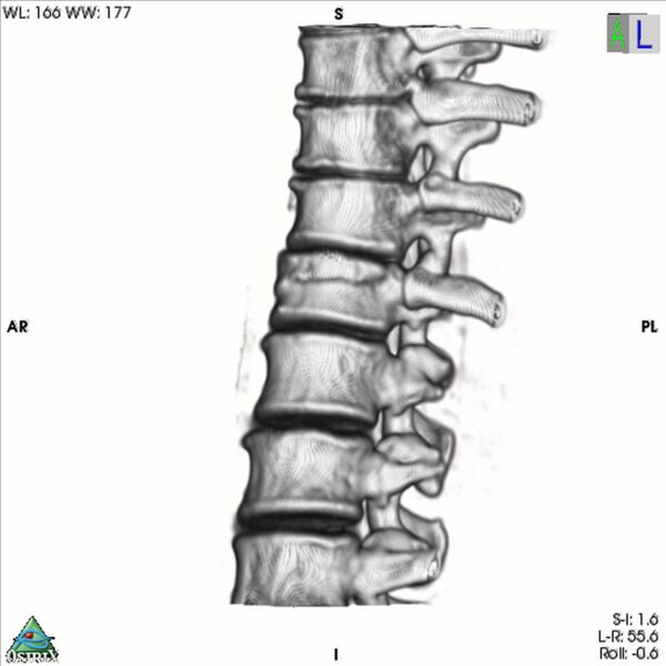 File:Bulging of paraspinal line in traumatic thoracal spinal compression fracture (Radiopaedia 29221-35872 3D VR 18).jpg