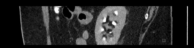 File:Buried bumper syndrome - gastrostomy tube (Radiopaedia 63843-72575 Sagittal Inject 30).jpg