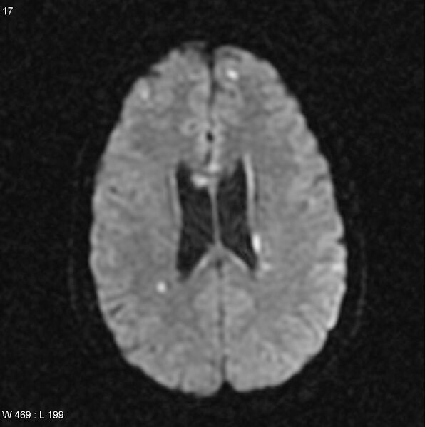 File:CMV ventriculitis and encephalitis (Radiopaedia 5416-7166 Axial DWI 6).jpg