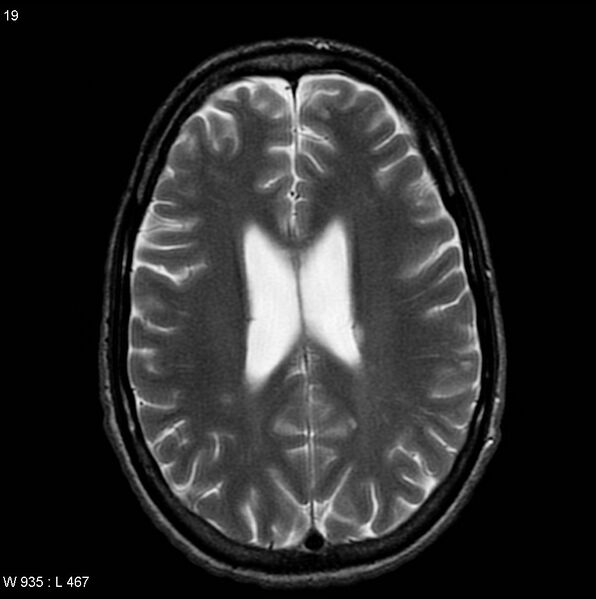 File:CMV ventriculitis and encephalitis (Radiopaedia 5416-7166 T2 5).jpg