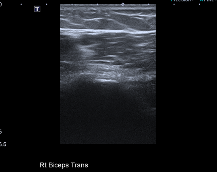 File:Calcific tendinitis (ruptured) (Radiopaedia 56393-63053 A 3).png