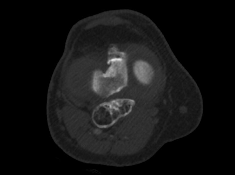 File:Calcified hematoma - popliteal fossa (Radiopaedia 63938-72763 C 25).jpg