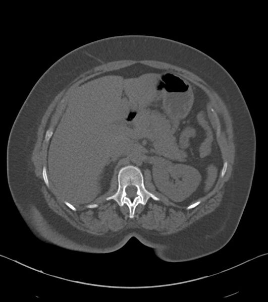 File:Calcified hepatic hydatid cyst (Radiopaedia 81127-94738 Axial non-contrast 32).jpg