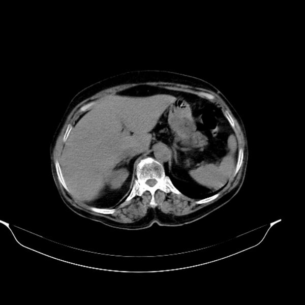 File:Calcified hydatid cyst (Radiopaedia 62000-70085 Axial non-contrast 31).jpg