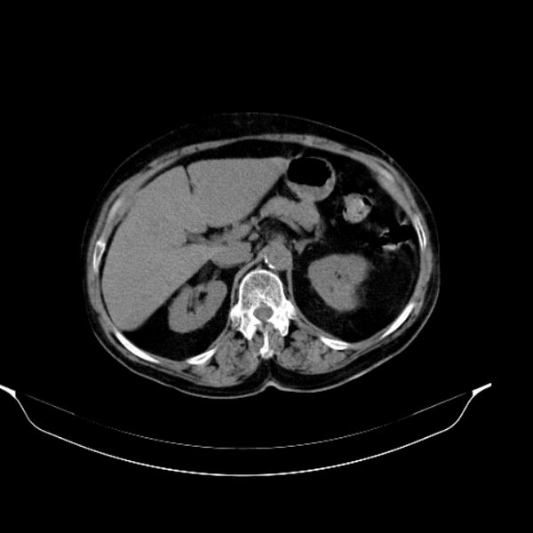 File:Calcified hydatid cyst (Radiopaedia 62000-70085 Axial non-contrast 36).jpg
