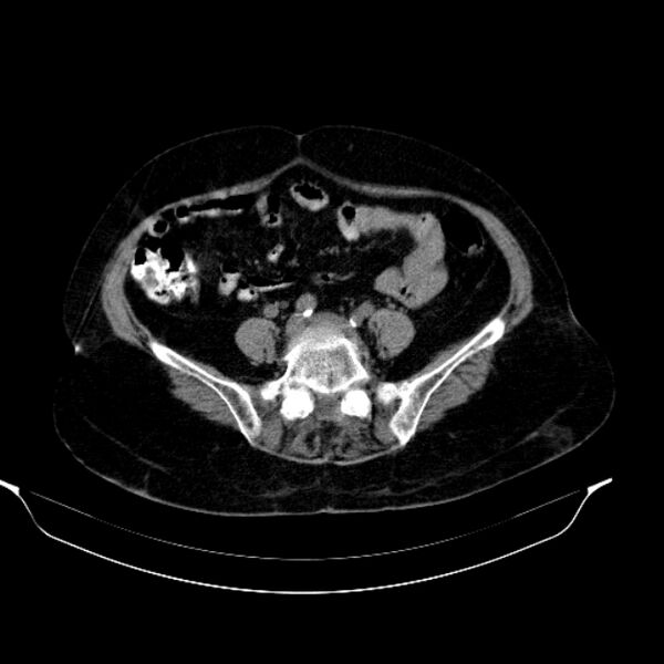 File:Calcified hydatid cyst (Radiopaedia 62000-70085 Axial non-contrast 75).jpg