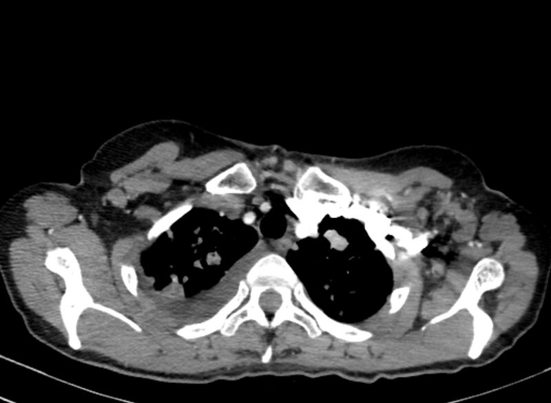 File:Cannonball metastases from breast cancer (Radiopaedia 91024-108569 A 24).jpg