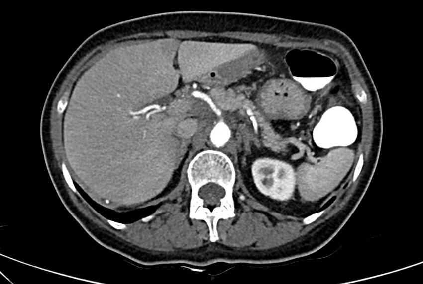 Carcinoid mesenteric tumor complicated by chylous ascites (Radiopaedia 76312-88926 A 19).jpg