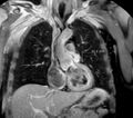 Cardiac hemangioma (Radiopaedia 16971-64065 Multiplanar 12).JPG