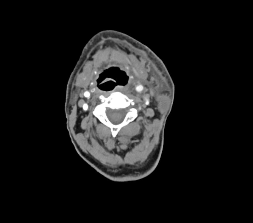 Carotid artery pseudoaneurysm (Radiopaedia 84030-99259 C 34).jpg