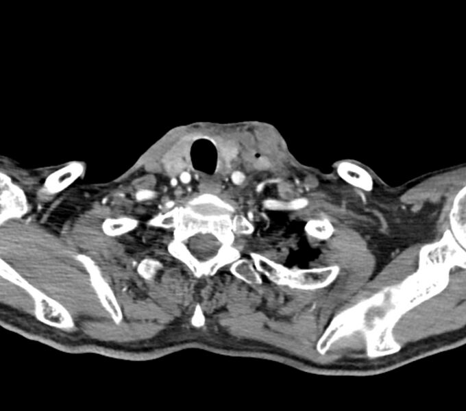 File:Carotid artery pseudoaneurysm (Radiopaedia 84030-99259 C 69).jpg