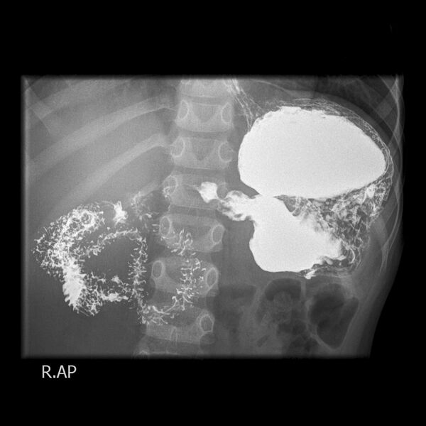 File:Caustic esophageal stricture (Radiopaedia 67290-76661 Supine 1).JPEG