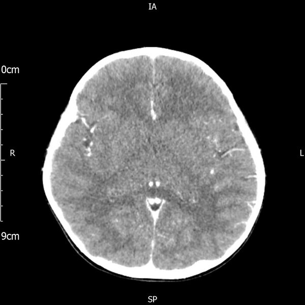 File:Cavernous sinus thrombosis (Radiopaedia 79414-92510 Axial Brain 107).jpg