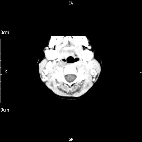 File:Cavernous sinus thrombosis (Radiopaedia 79414-92510 Axial Brain 12).jpg