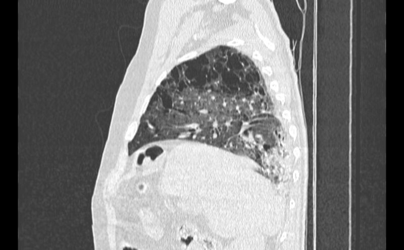 File:Cavitating bronchogenic carcinoma (Radiopaedia 44489-48162 Sagittal lung window 12).jpg