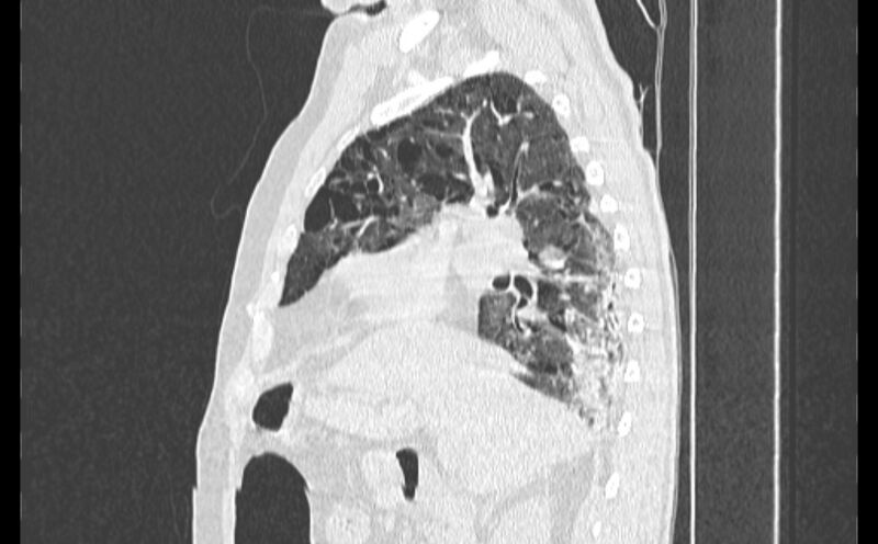File:Cavitating bronchogenic carcinoma (Radiopaedia 44489-48162 Sagittal lung window 19).jpg