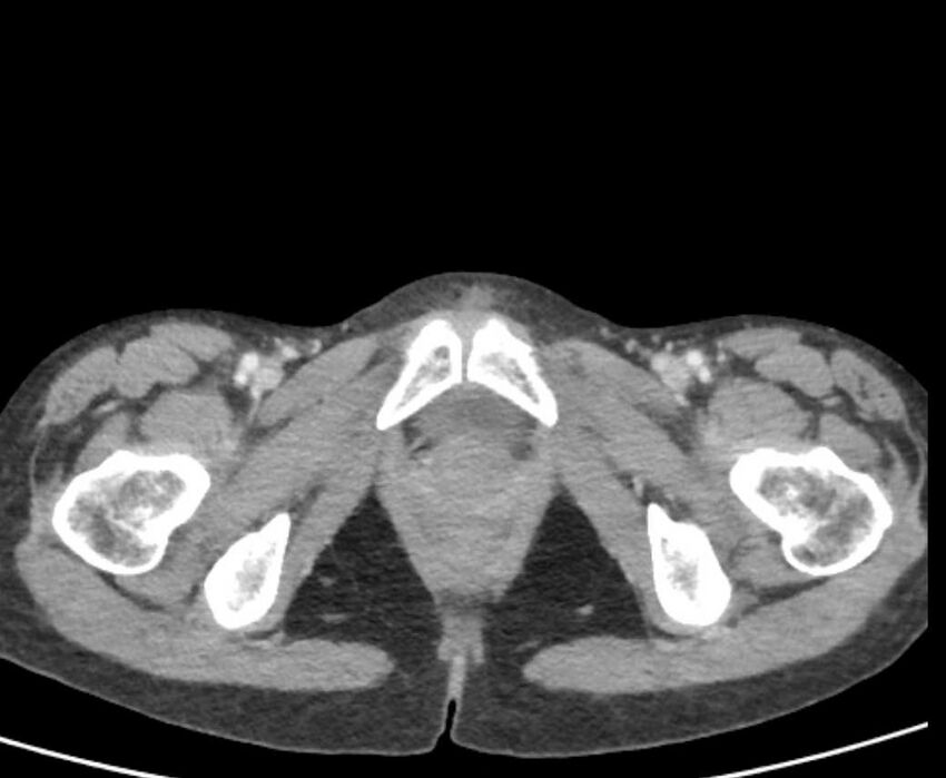 Cecal volvulus with pneumatosis coli (Radiopaedia 68572-78178 A 127).jpg
