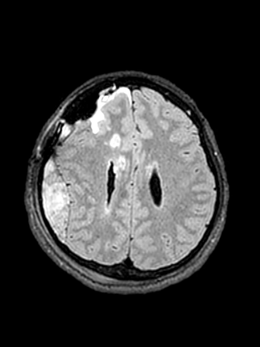 Central neurocytoma (Radiopaedia 79320-92381 Axial FLAIR 60).jpg