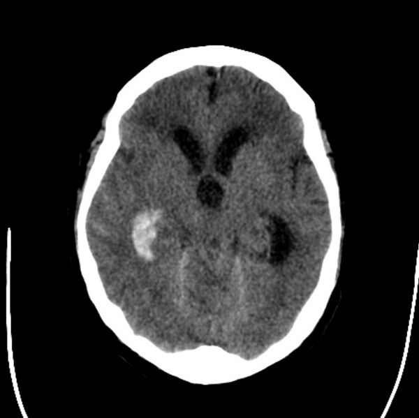 File:Cerebellar hemorrhage causing obstructive hydrocephalus (Radiopaedia 33989-35207 Axial non-contrast 21).jpg