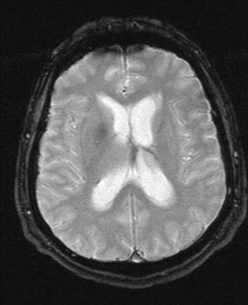 File:Cerebellopontine angle meningioma (Radiopaedia 24459-24764 Axial Gradient Echo 14).jpg