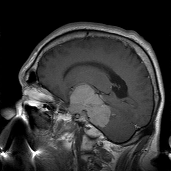 File:Cerebellopontine angle meningioma (Radiopaedia 24459-24764 Sagittal T1 C+ 9).jpg
