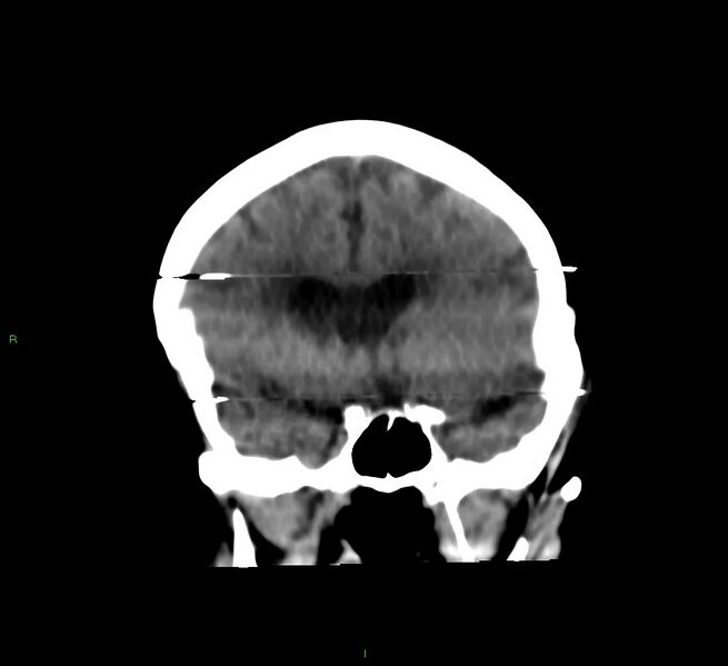 File:Cerebral amyloid angiopathy-associated lobar intracerebral hemorrhage (Radiopaedia 58377-65514 Coronal non-contrast 42).jpg