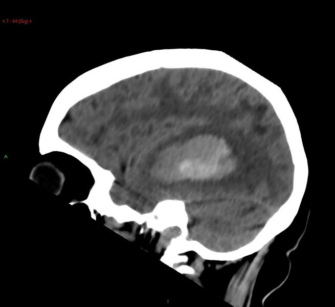File:Cerebral amyloid angiopathy-associated lobar intracerebral hemorrhage (Radiopaedia 58378-65518 C 44).jpg