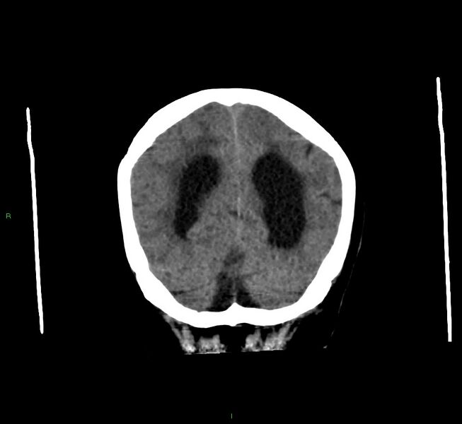 File:Cerebral amyloid angiopathy-associated lobar intracerebral hemorrhage (Radiopaedia 58560-65723 Coronal non-contrast 18).jpg