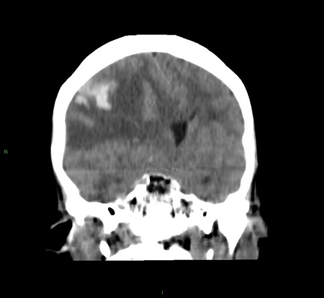 File:Cerebral amyloid angiopathy-associated lobar intracerebral hemorrhage (Radiopaedia 58751-65972 Coronal non-contrast 35).jpg