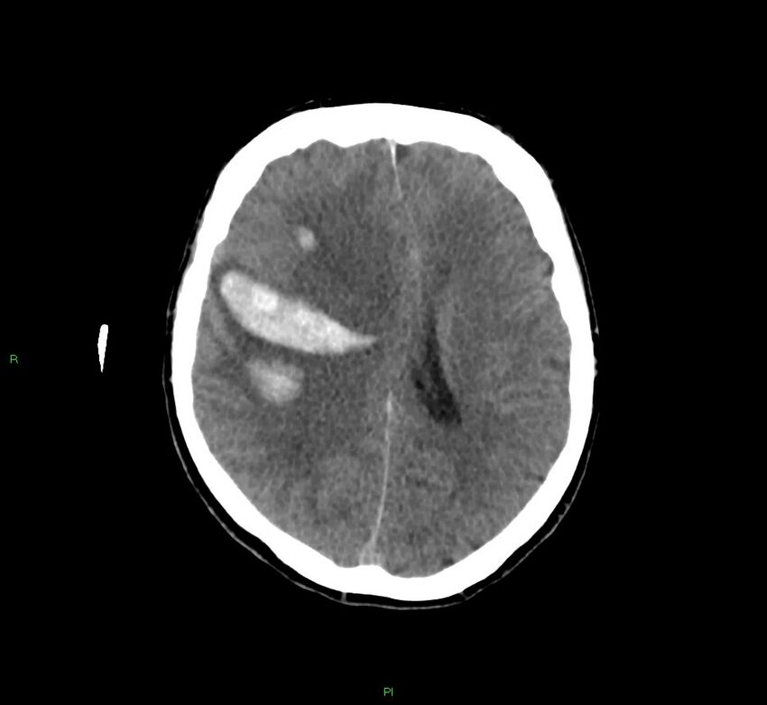 Cerebral amyloid angiopathy-associated lobar intracerebral hemorrhage (Radiopaedia 58756-65977 Axial non-contrast 23).jpg