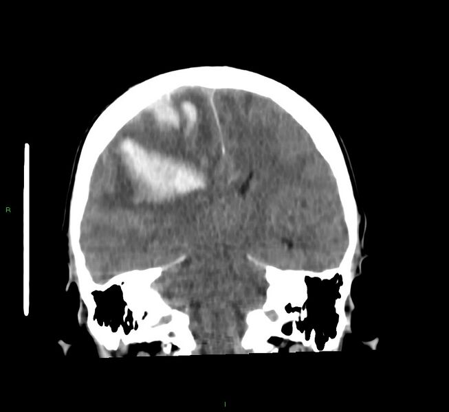 File:Cerebral amyloid angiopathy-associated lobar intracerebral hemorrhage (Radiopaedia 58756-65977 Coronal non-contrast 31).jpg