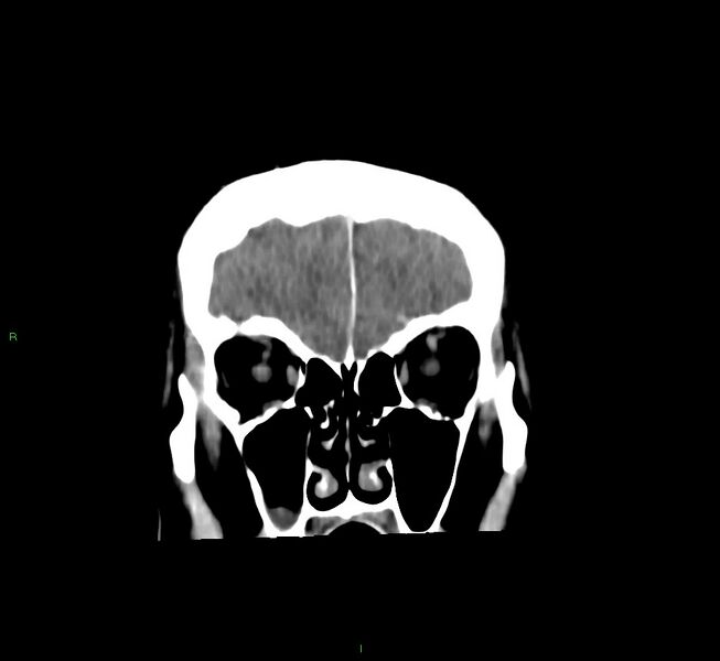 File:Cerebral amyloid angiopathy-associated lobar intracerebral hemorrhage (Radiopaedia 58756-65977 Coronal non-contrast 53).jpg