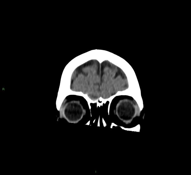 File:Cerebral amyloid angiopathy-associated lobar intracerebral hemorrhage (Radiopaedia 58757-65978 Coronal non-contrast 58).jpg