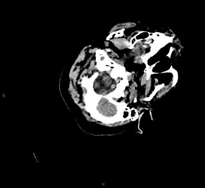 File:Cerebral amyloid angiopathy-associated lobar intracerebral hemorrhage (Radiopaedia 58757-65979 Axial non-contrast 15).jpg