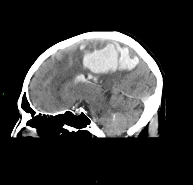 File:Cerebral amyloid angiopathy-associated lobar intracerebral hemorrhage (Radiopaedia 59356-66716 C 26).jpg