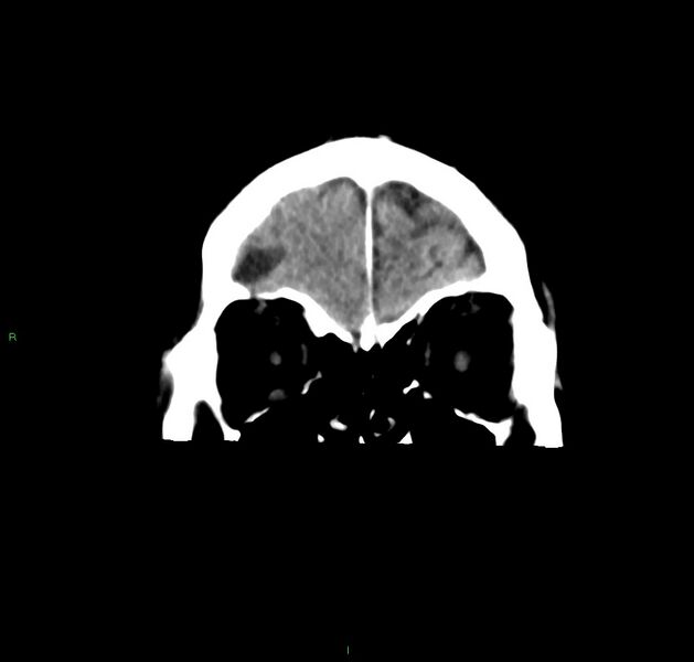 File:Cerebral amyloid angiopathy-associated lobar intracerebral hemorrhage (Radiopaedia 59356-66716 Coronal non-contrast 55).jpg