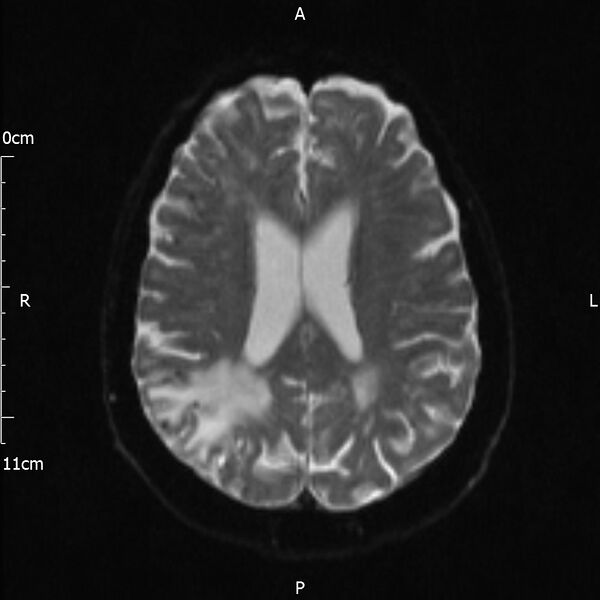 File:Cerebral amyloid angiopathy related inflammation (Radiopaedia 72772-83415 Axial DWI 15).jpg
