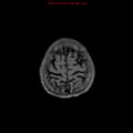 Cerebral and orbital tuberculomas (Radiopaedia 13308-13311 Axial T1 C+ 19).jpg
